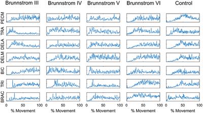 Alterations of Muscle Synergies During Voluntary Arm Reaching Movement in Subacute Stroke Survivors at Different Levels of Impairment